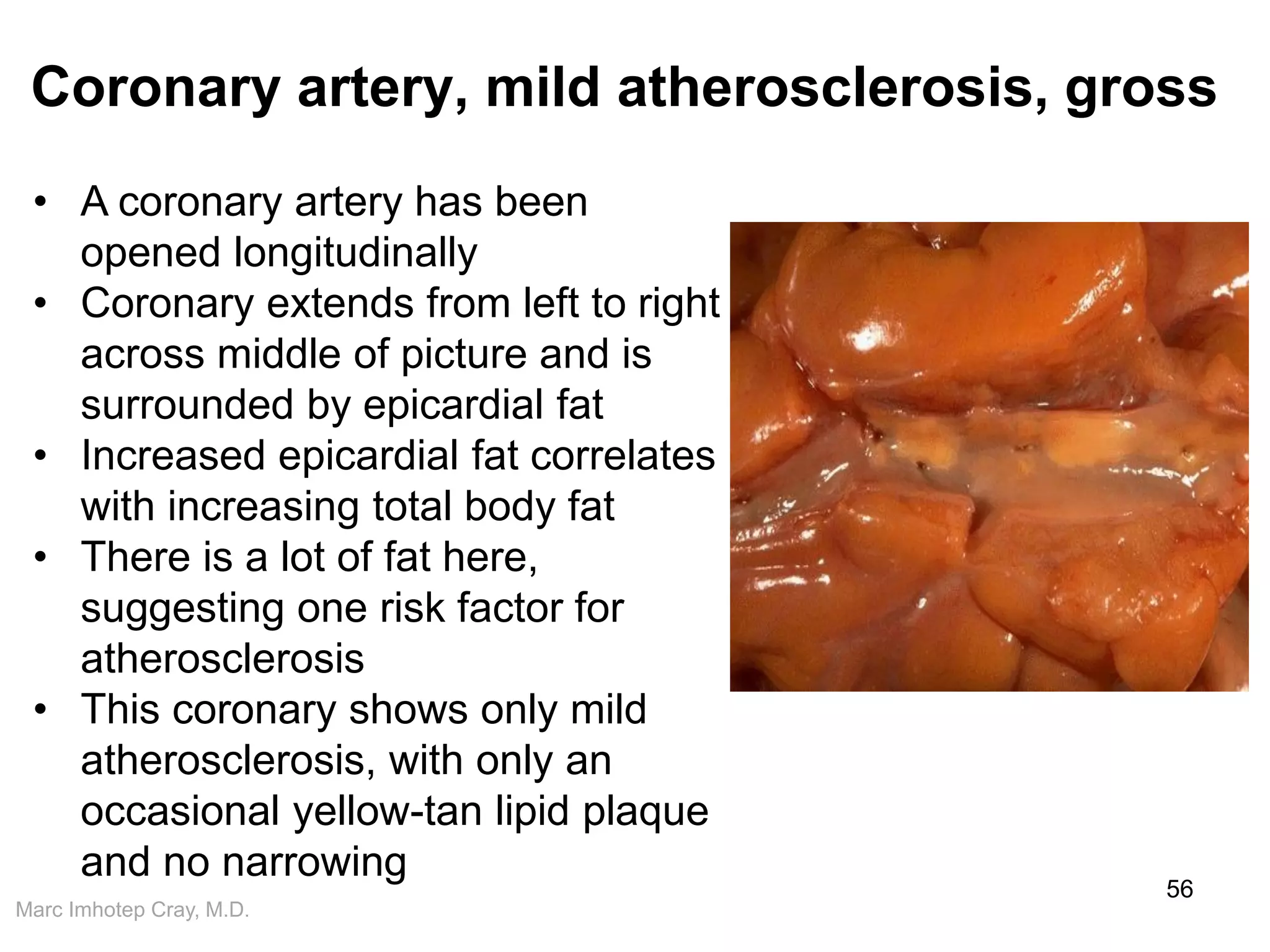 Marc Imhotep Cray, M.D.
Coronary artery, mild atherosclerosis, gross
56
• A coronary artery has been
opened longitudinally
• Coronary extends from left to right
across middle of picture and is
surrounded by epicardial fat
• Increased epicardial fat correlates
with increasing total body fat
• There is a lot of fat here,
suggesting one risk factor for
atherosclerosis
• This coronary shows only mild
atherosclerosis, with only an
occasional yellow-tan lipid plaque
and no narrowing
 