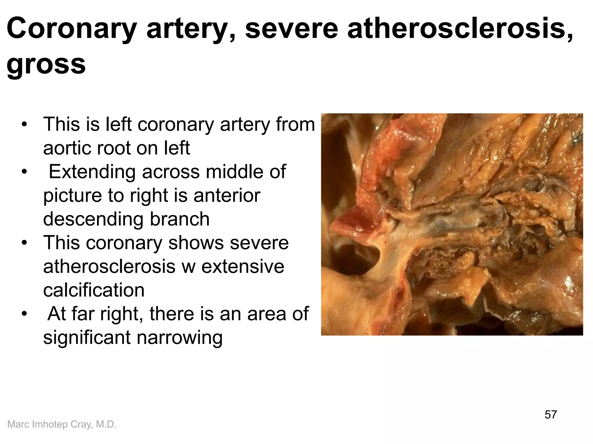 Marc Imhotep Cray, M.D.
Coronary artery, severe atherosclerosis,
gross
57
• This is left coronary artery from
aortic root on left
• Extending across middle of
picture to right is anterior
descending branch
• This coronary shows severe
atherosclerosis w extensive
calcification
• At far right, there is an area of
significant narrowing
 