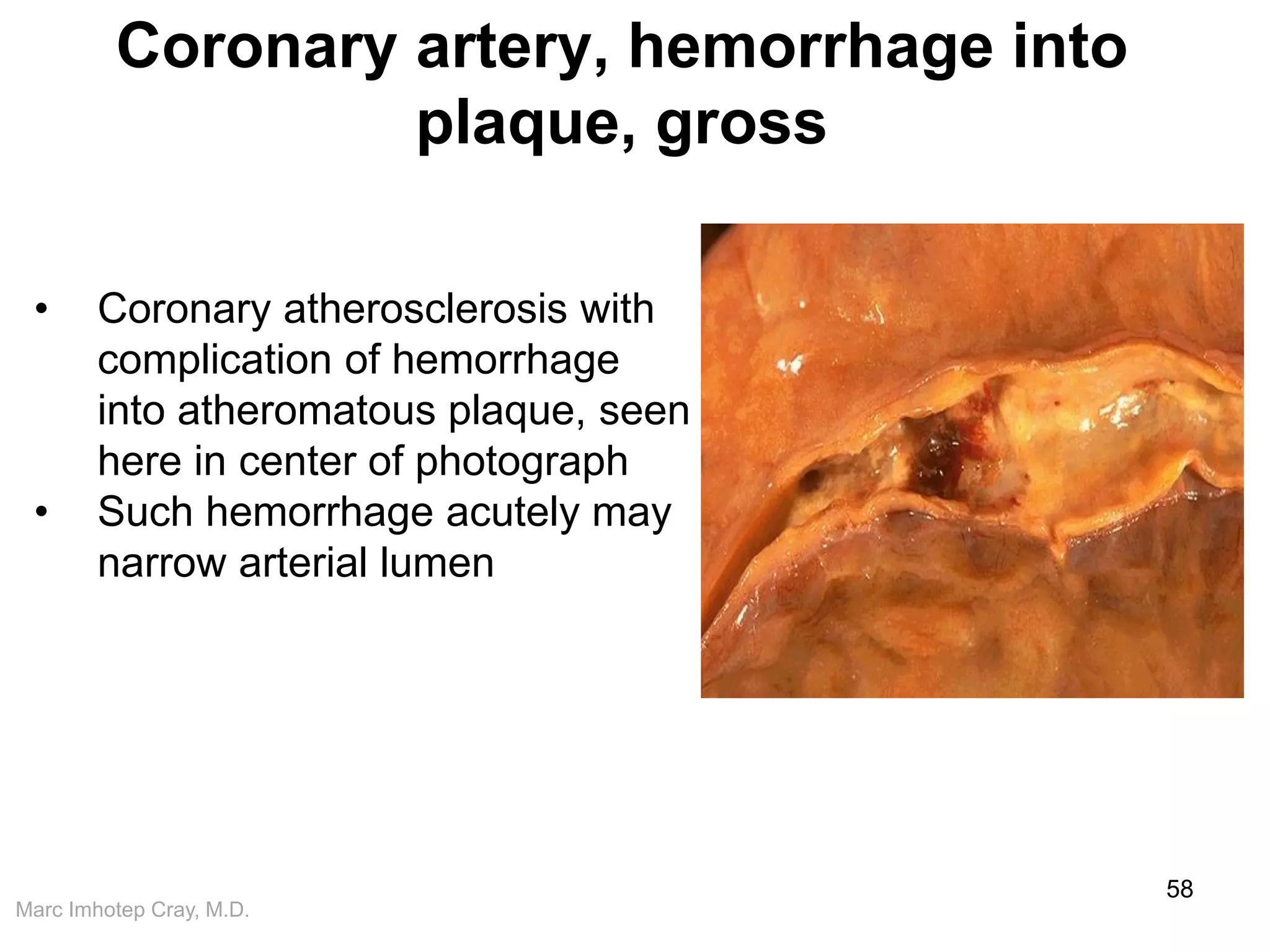 Marc Imhotep Cray, M.D.
Coronary artery, hemorrhage into
plaque, gross
58
• Coronary atherosclerosis with
complication of hemorrhage
into atheromatous plaque, seen
here in center of photograph
• Such hemorrhage acutely may
narrow arterial lumen
 