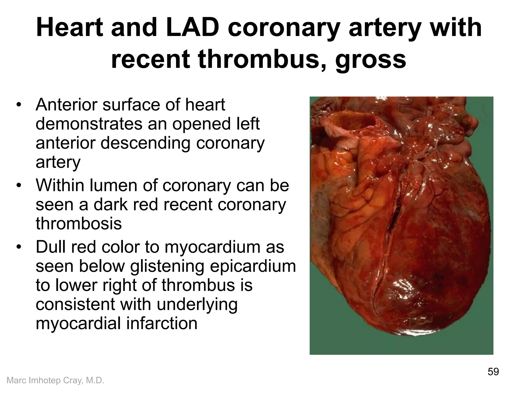 Marc Imhotep Cray, M.D.
Heart and LAD coronary artery with
recent thrombus, gross
• Anterior surface of heart
demonstrates an opened left
anterior descending coronary
artery
• Within lumen of coronary can be
seen a dark red recent coronary
thrombosis
• Dull red color to myocardium as
seen below glistening epicardium
to lower right of thrombus is
consistent with underlying
myocardial infarction
59
 