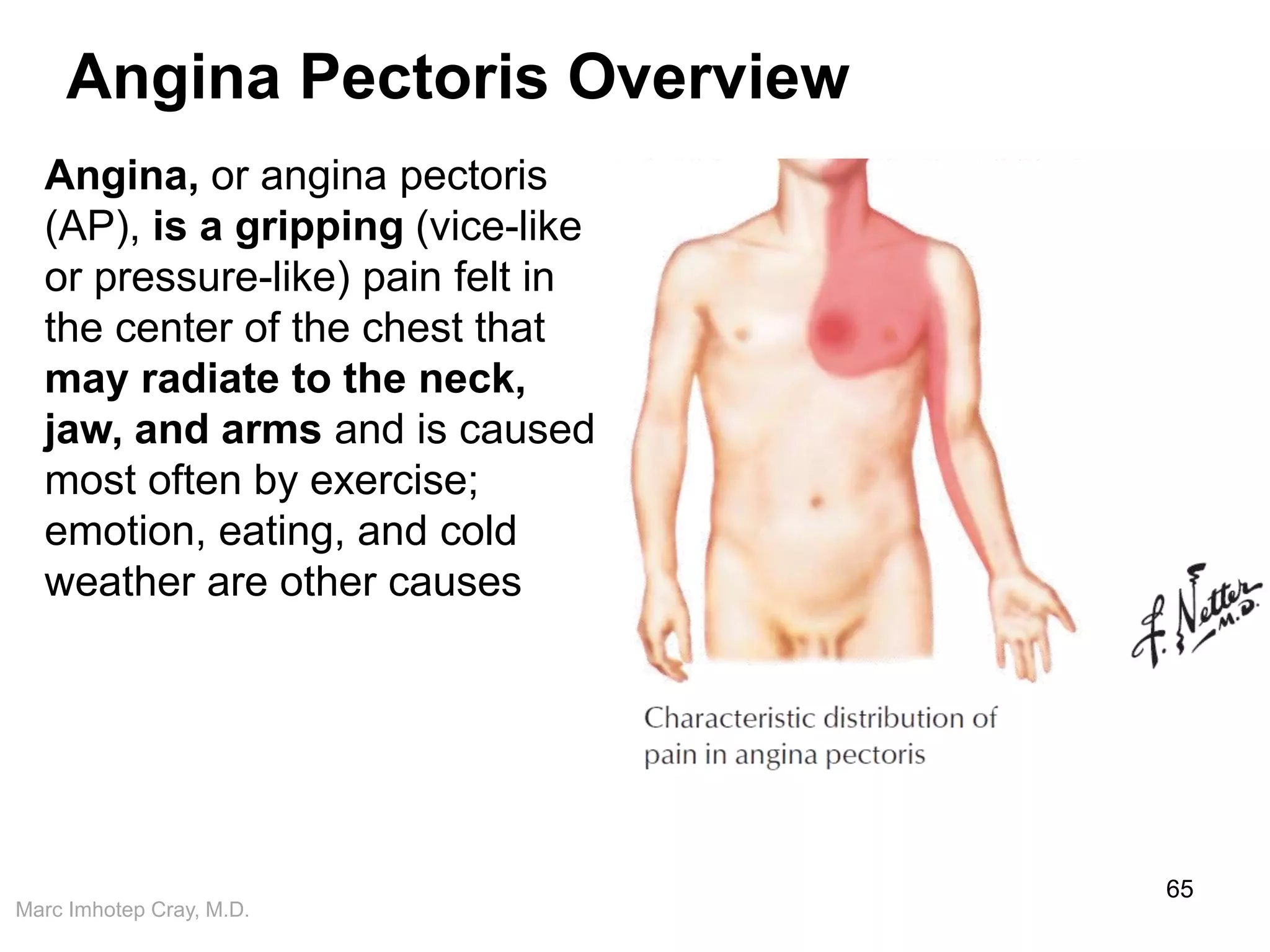 Marc Imhotep Cray, M.D.
Angina Pectoris Overview
65
Angina, or angina pectoris
(AP), is a gripping (vice-like
or pressure-like) pain felt in
the center of the chest that
may radiate to the neck,
jaw, and arms and is caused
most often by exercise;
emotion, eating, and cold
weather are other causes
 
