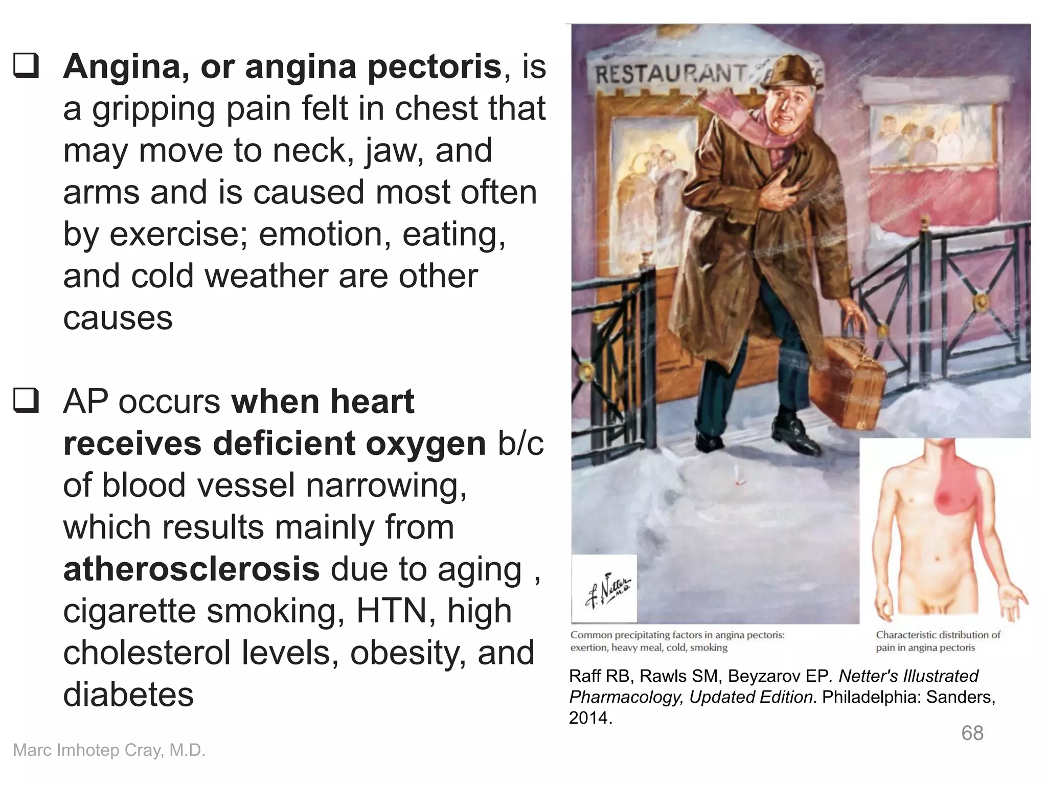 Marc Imhotep Cray, M.D.
68
Raff RB, Rawls SM, Beyzarov EP. Netter's Illustrated
Pharmacology, Updated Edition. Philadelphia: Sanders,
2014.
 Angina, or angina pectoris, is
a gripping pain felt in chest that
may move to neck, jaw, and
arms and is caused most often
by exercise; emotion, eating,
and cold weather are other
causes
 AP occurs when heart
receives deficient oxygen b/c
of blood vessel narrowing,
which results mainly from
atherosclerosis due to aging ,
cigarette smoking, HTN, high
cholesterol levels, obesity, and
diabetes
 