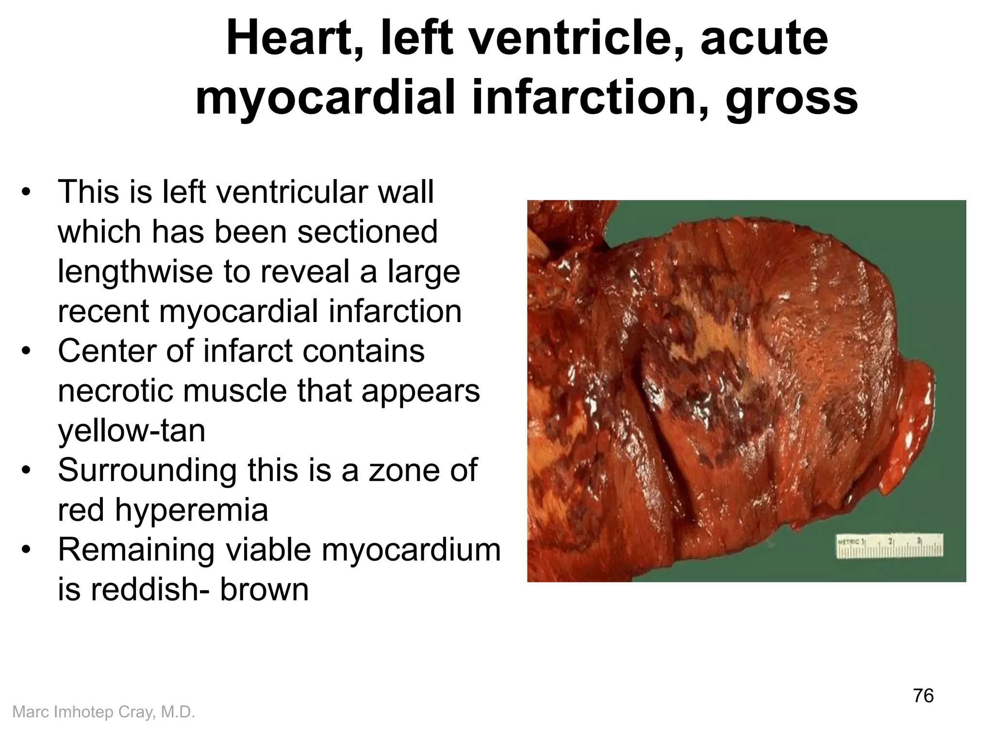Marc Imhotep Cray, M.D.
Heart, left ventricle, acute
myocardial infarction, gross
76
• This is left ventricular wall
which has been sectioned
lengthwise to reveal a large
recent myocardial infarction
• Center of infarct contains
necrotic muscle that appears
yellow-tan
• Surrounding this is a zone of
red hyperemia
• Remaining viable myocardium
is reddish- brown
 