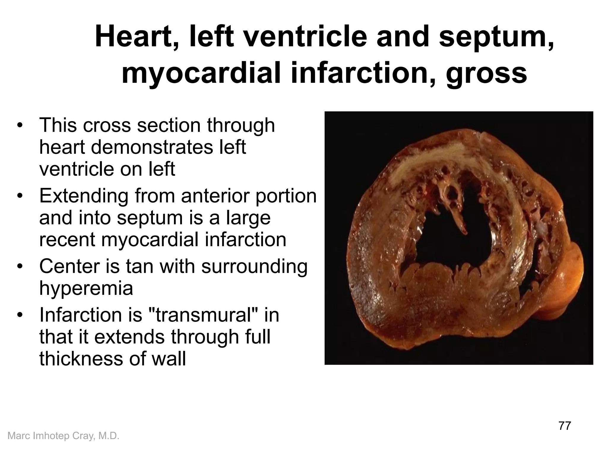 Marc Imhotep Cray, M.D.
Heart, left ventricle and septum,
myocardial infarction, gross
• This cross section through
heart demonstrates left
ventricle on left
• Extending from anterior portion
and into septum is a large
recent myocardial infarction
• Center is tan with surrounding
hyperemia
• Infarction is "transmural" in
that it extends through full
thickness of wall
77
 