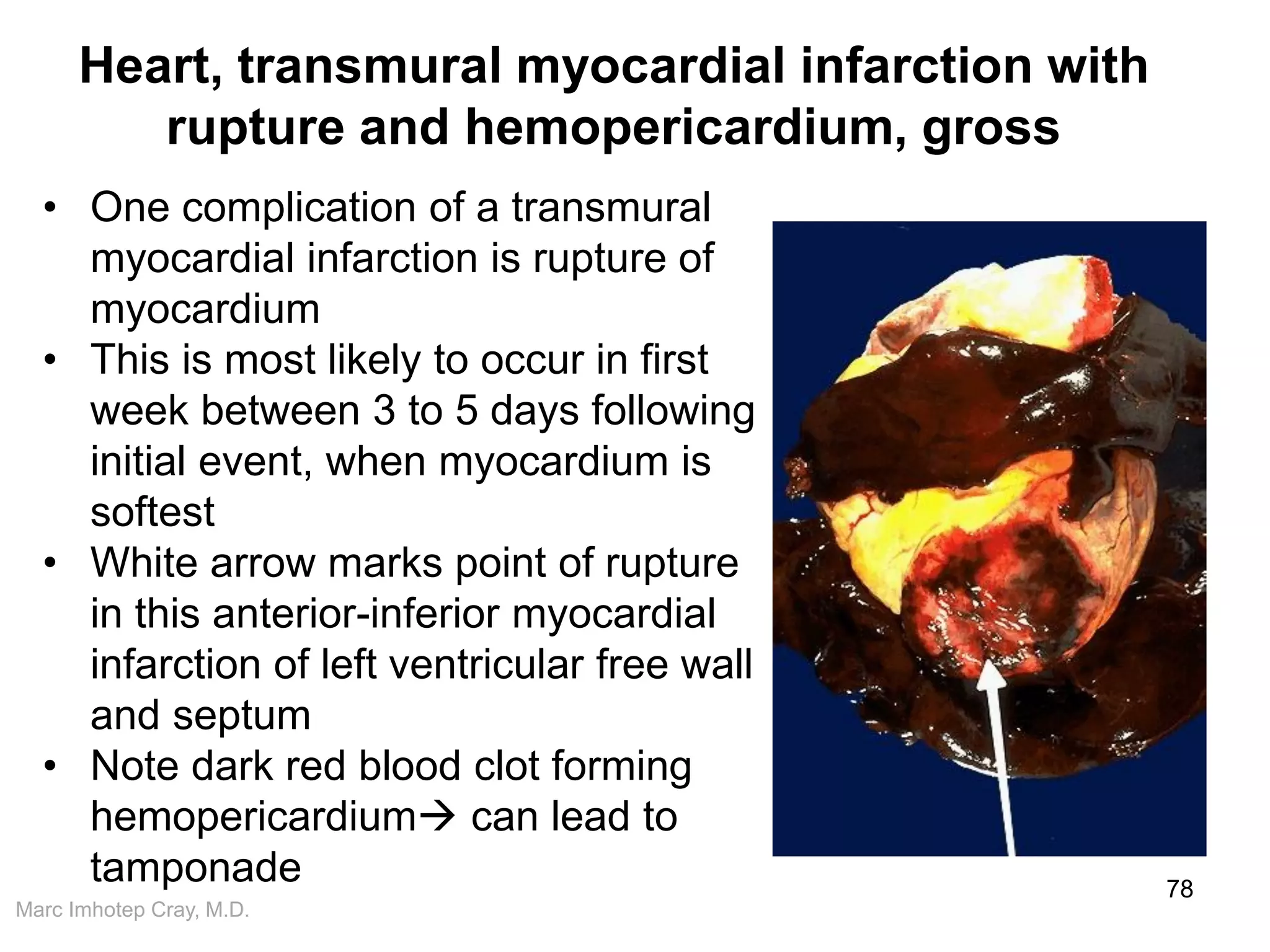 Marc Imhotep Cray, M.D.
Heart, transmural myocardial infarction with
rupture and hemopericardium, gross
78
• One complication of a transmural
myocardial infarction is rupture of
myocardium
• This is most likely to occur in first
week between 3 to 5 days following
initial event, when myocardium is
softest
• White arrow marks point of rupture
in this anterior-inferior myocardial
infarction of left ventricular free wall
and septum
• Note dark red blood clot forming
hemopericardium can lead to
tamponade
 