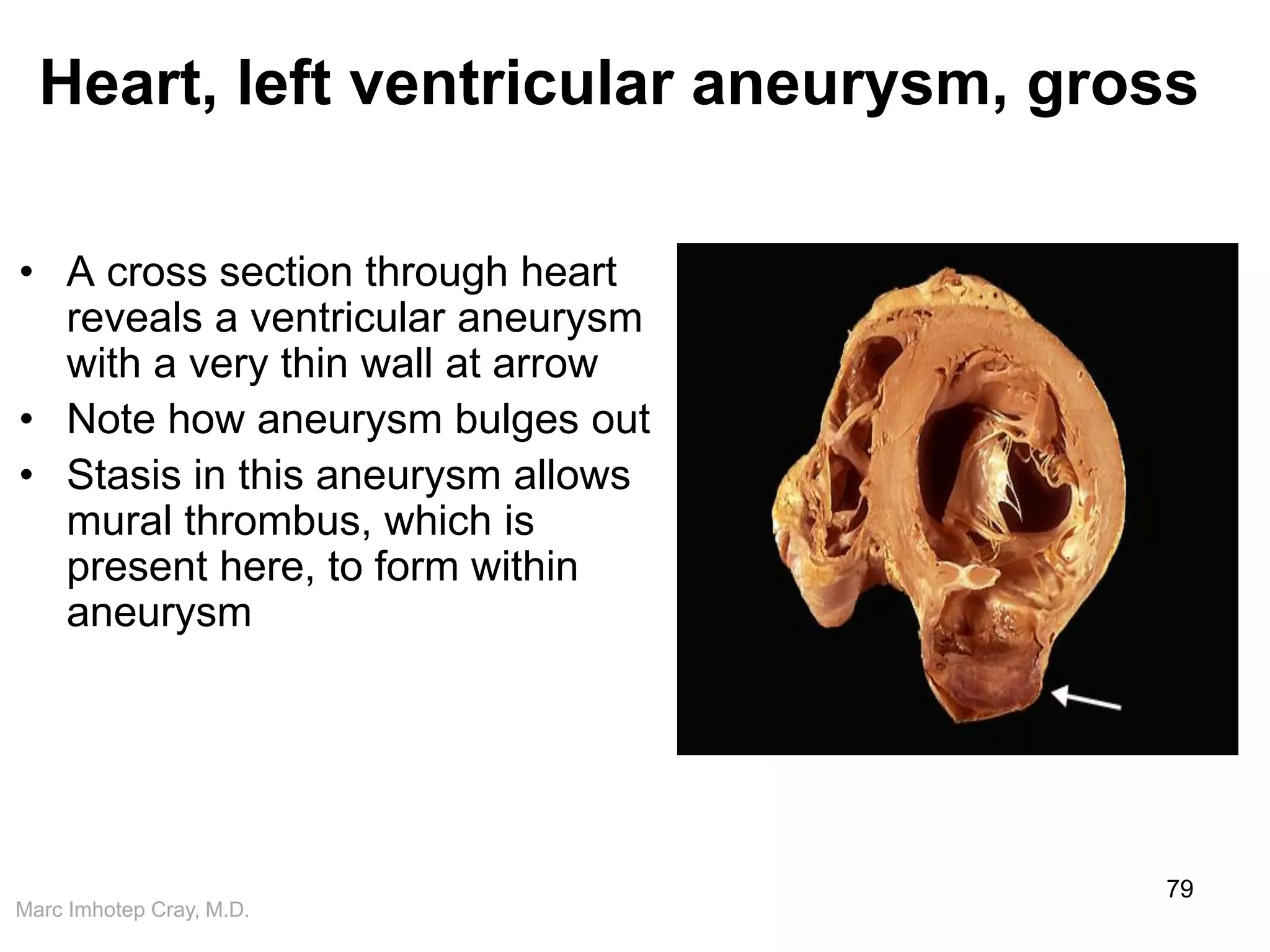 Marc Imhotep Cray, M.D.
Heart, left ventricular aneurysm, gross
• A cross section through heart
reveals a ventricular aneurysm
with a very thin wall at arrow
• Note how aneurysm bulges out
• Stasis in this aneurysm allows
mural thrombus, which is
present here, to form within
aneurysm
79
 
