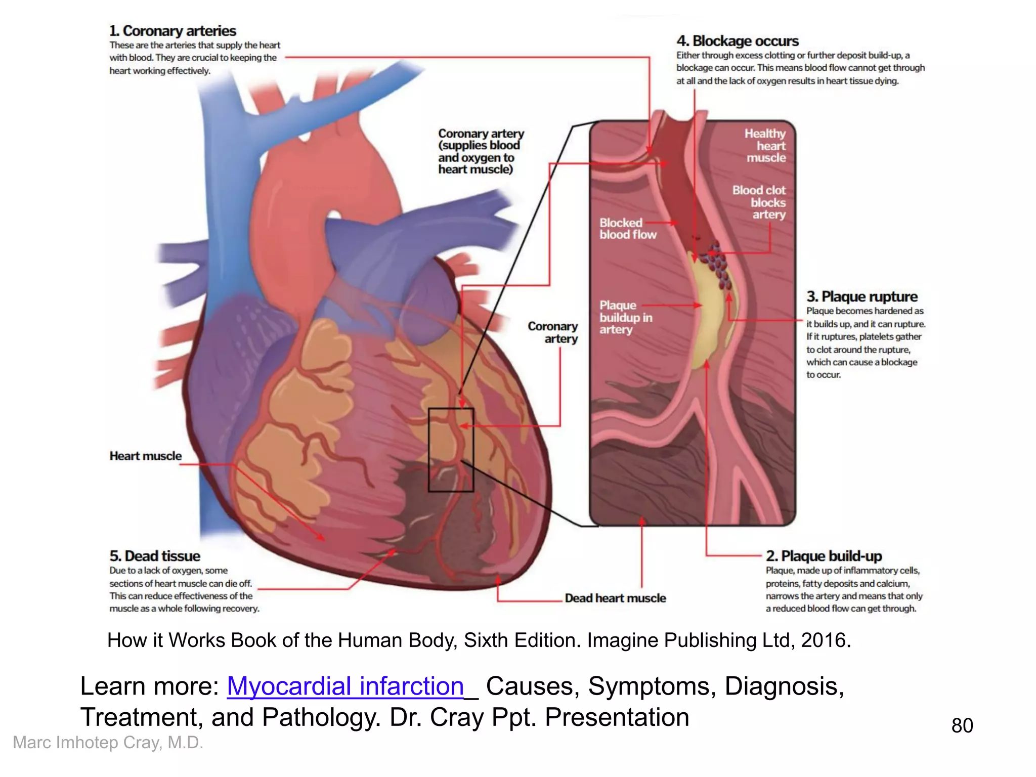 Marc Imhotep Cray, M.D.
80
How it Works Book of the Human Body, Sixth Edition. Imagine Publishing Ltd, 2016.
Learn more: Myocardial infarction_ Causes, Symptoms, Diagnosis,
Treatment, and Pathology. Dr. Cray Ppt. Presentation
 