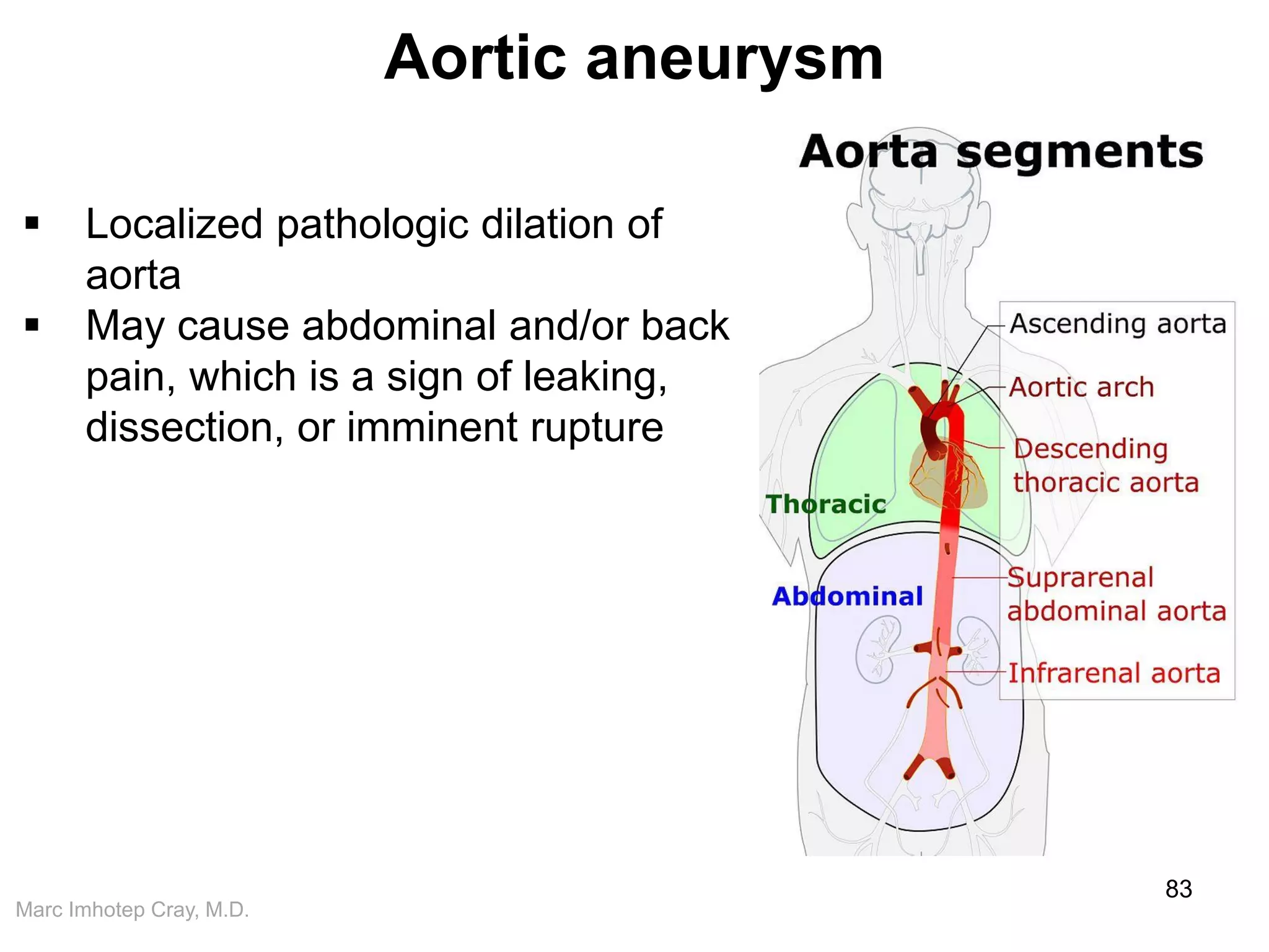 Marc Imhotep Cray, M.D.
Aortic aneurysm
83
 Localized pathologic dilation of
aorta
 May cause abdominal and/or back
pain, which is a sign of leaking,
dissection, or imminent rupture
 