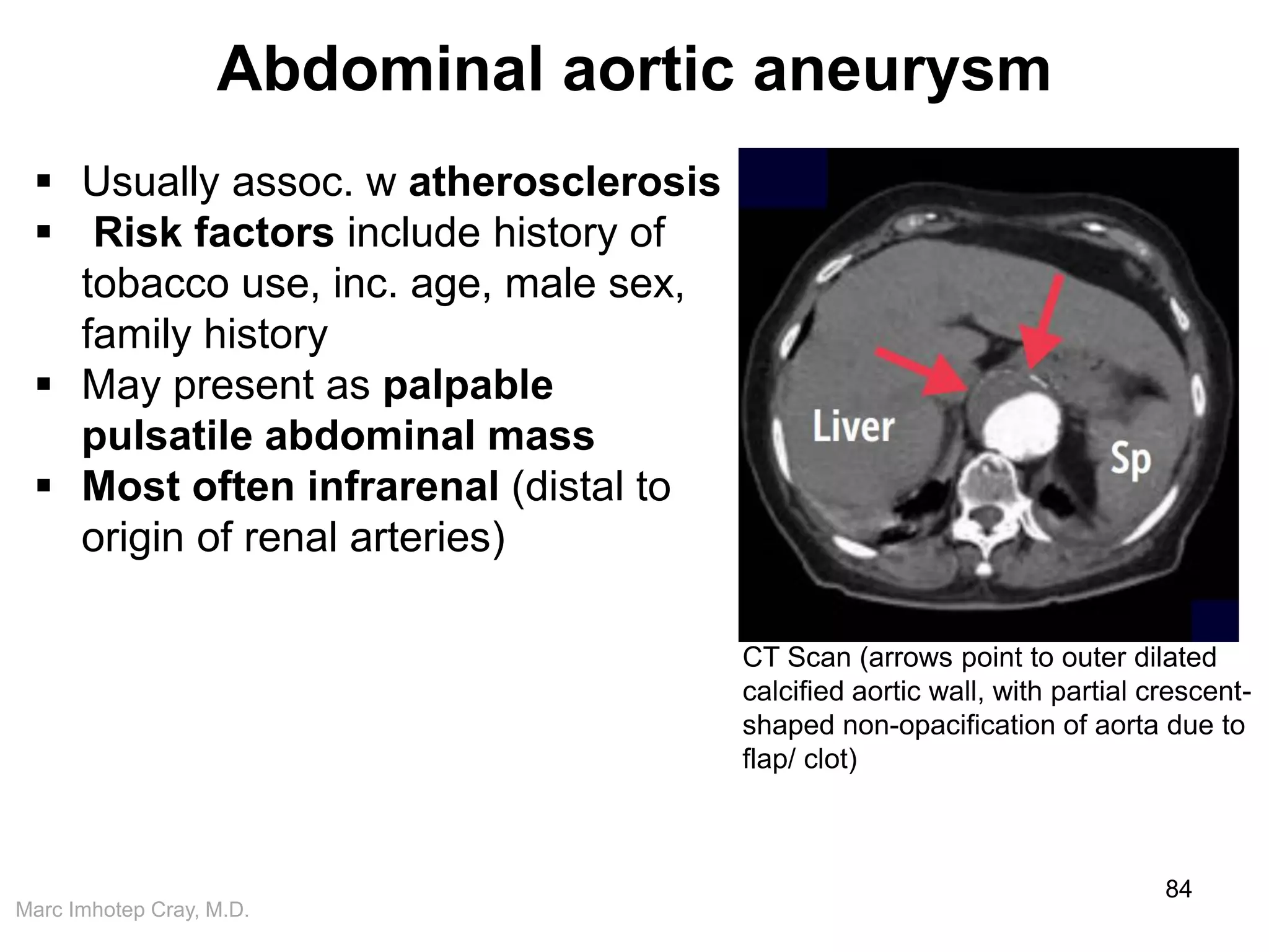 Marc Imhotep Cray, M.D.
Abdominal aortic aneurysm
84
 Usually assoc. w atherosclerosis
 Risk factors include history of
tobacco use, inc. age, male sex,
family history
 May present as palpable
pulsatile abdominal mass
 Most often infrarenal (distal to
origin of renal arteries)
CT Scan (arrows point to outer dilated
calcified aortic wall, with partial crescent-
shaped non-opacification of aorta due to
flap/ clot)
 