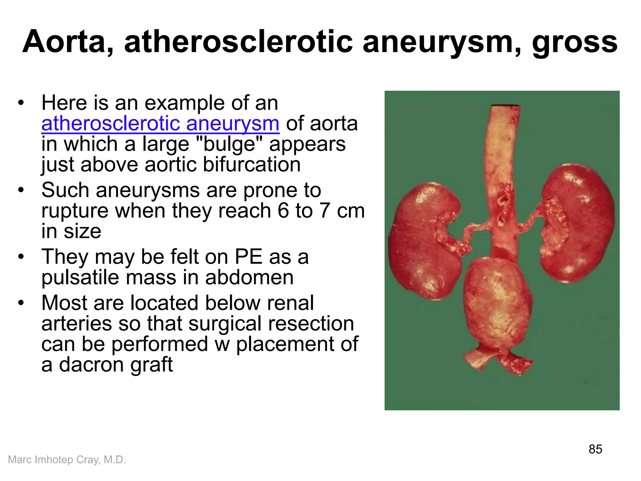 Marc Imhotep Cray, M.D.
Aorta, atherosclerotic aneurysm, gross
• Here is an example of an
atherosclerotic aneurysm of aorta
in which a large "bulge" appears
just above aortic bifurcation
• Such aneurysms are prone to
rupture when they reach 6 to 7 cm
in size
• They may be felt on PE as a
pulsatile mass in abdomen
• Most are located below renal
arteries so that surgical resection
can be performed w placement of
a dacron graft
85
 