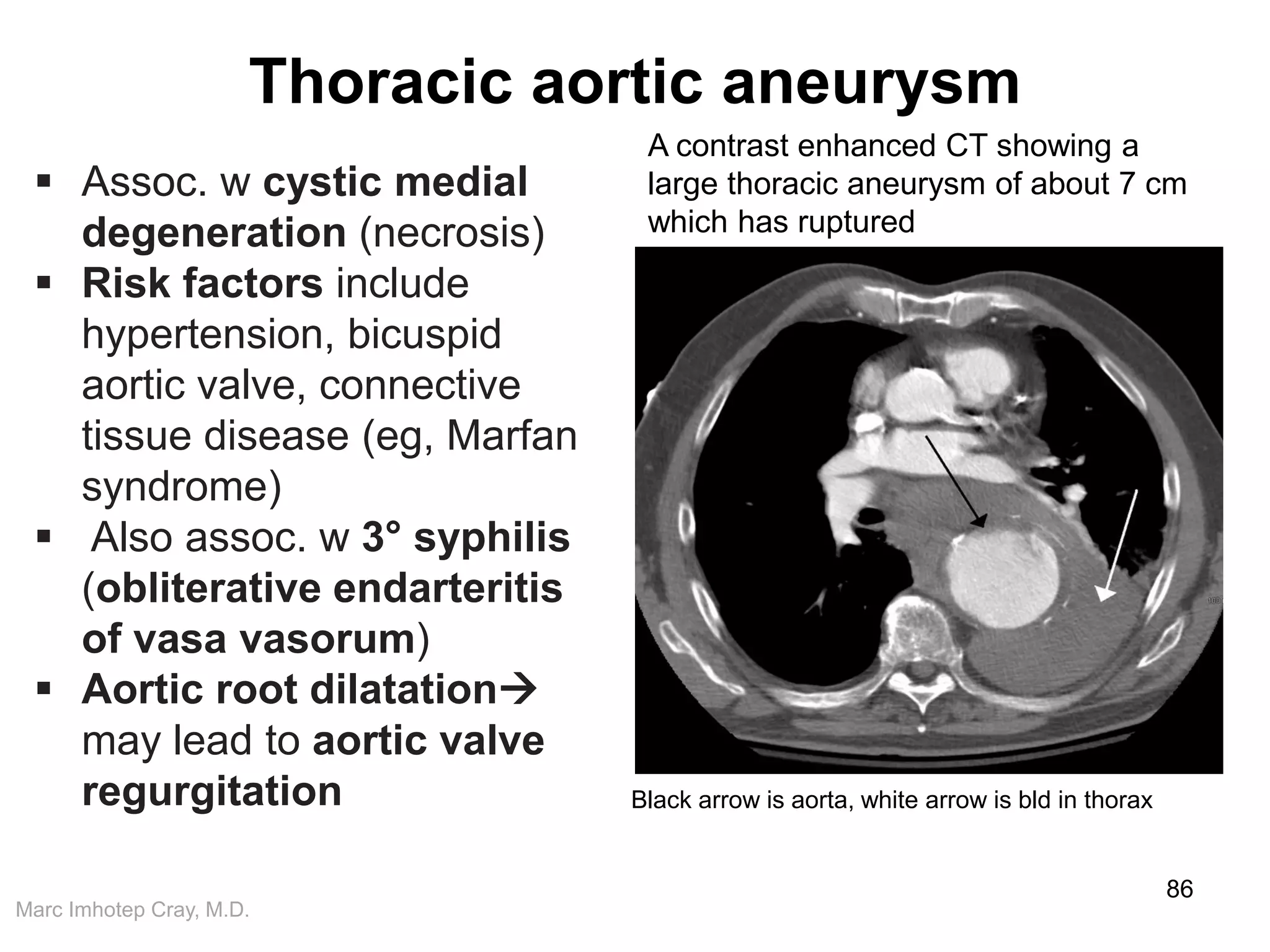 Marc Imhotep Cray, M.D.
Thoracic aortic aneurysm
86
 Assoc. w cystic medial
degeneration (necrosis)
 Risk factors include
hypertension, bicuspid
aortic valve, connective
tissue disease (eg, Marfan
syndrome)
 Also assoc. w 3° syphilis
(obliterative endarteritis
of vasa vasorum)
 Aortic root dilatation
may lead to aortic valve
regurgitation
A contrast enhanced CT showing a
large thoracic aneurysm of about 7 cm
which has ruptured
Black arrow is aorta, white arrow is bld in thorax
 