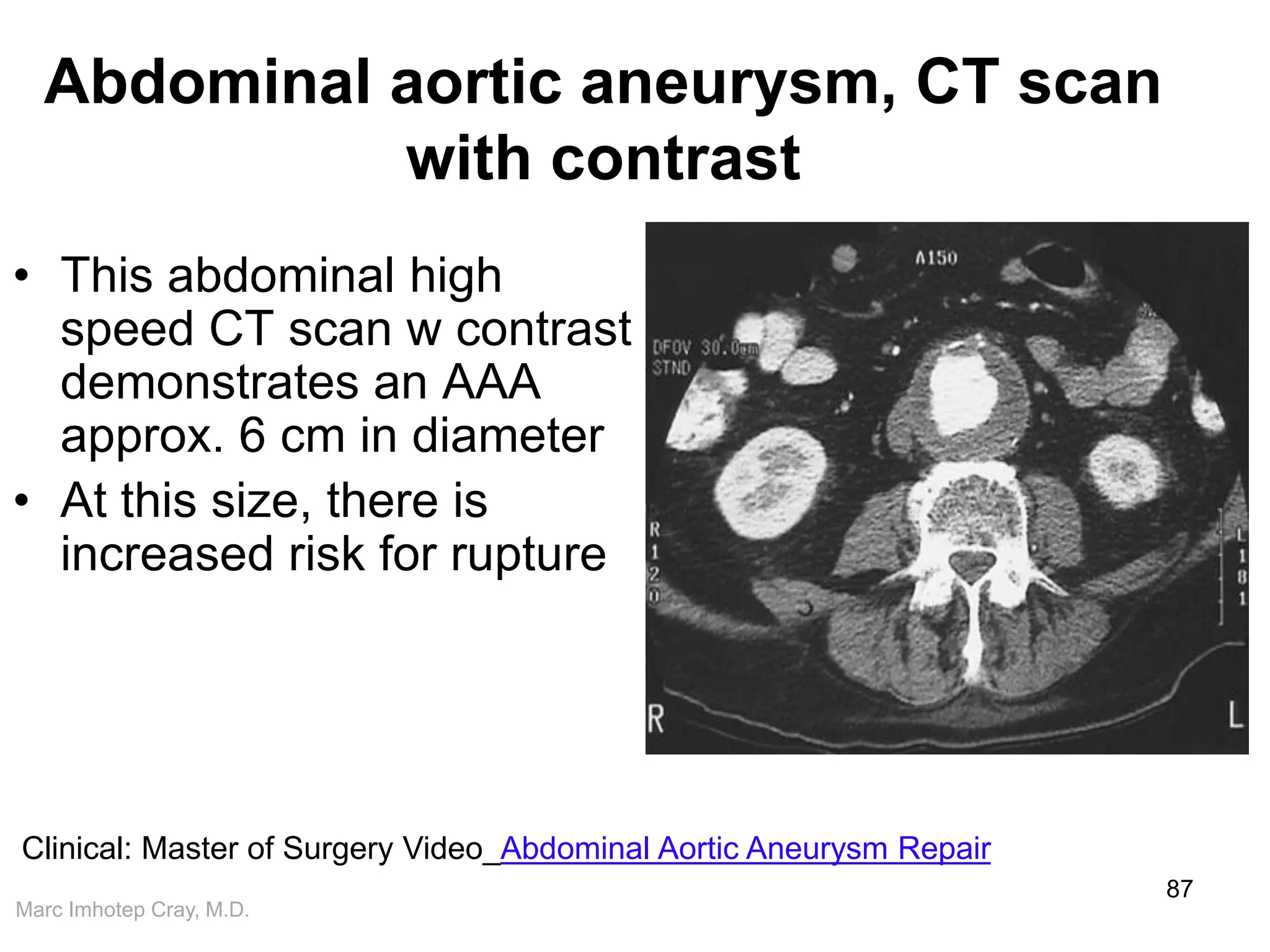 Marc Imhotep Cray, M.D.
Abdominal aortic aneurysm, CT scan
with contrast
• This abdominal high
speed CT scan w contrast
demonstrates an AAA
approx. 6 cm in diameter
• At this size, there is
increased risk for rupture
87
Clinical: Master of Surgery Video_Abdominal Aortic Aneurysm Repair
 