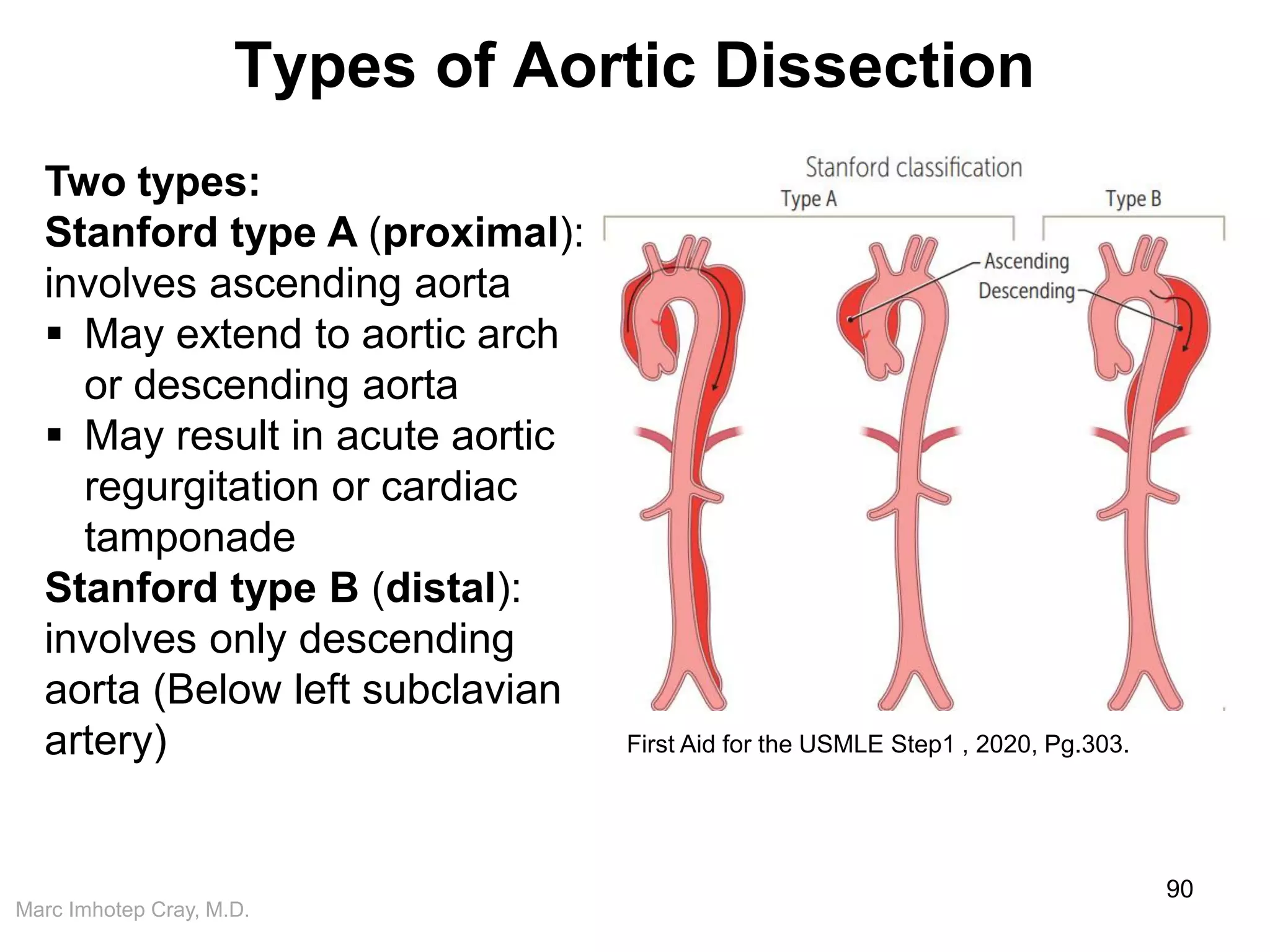 Marc Imhotep Cray, M.D.
Types of Aortic Dissection
90
Two types:
Stanford type A (proximal):
involves ascending aorta
 May extend to aortic arch
or descending aorta
 May result in acute aortic
regurgitation or cardiac
tamponade
Stanford type B (distal):
involves only descending
aorta (Below left subclavian
artery) First Aid for the USMLE Step1 , 2020, Pg.303.
 