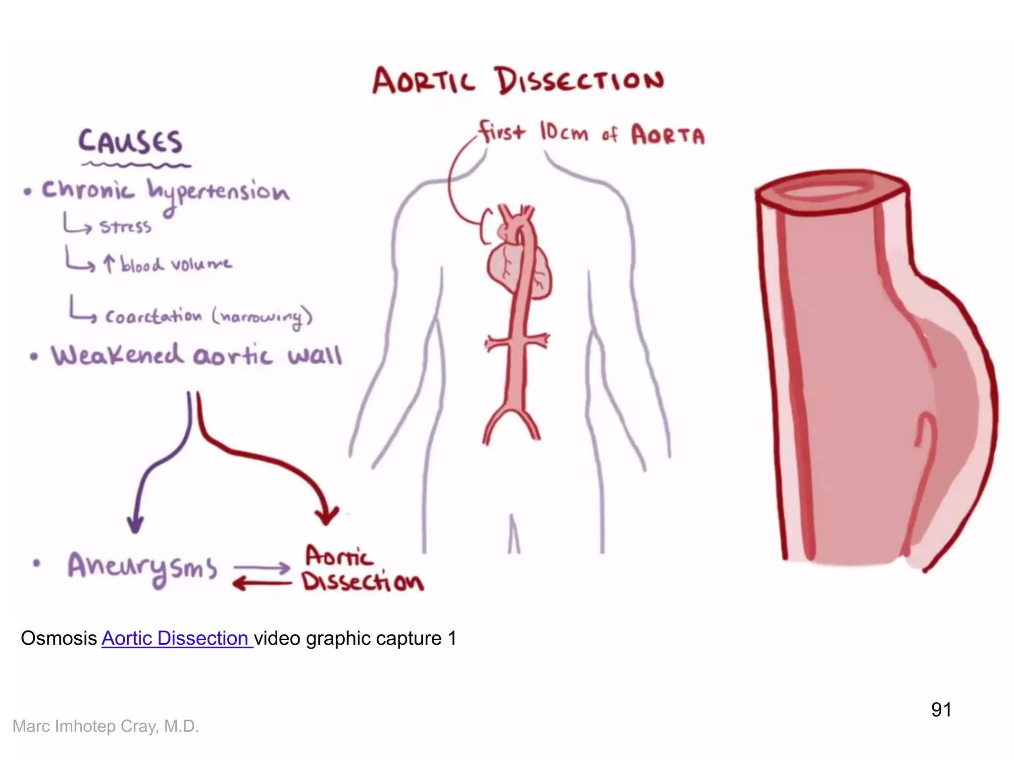 Marc Imhotep Cray, M.D.
91
Osmosis Aortic Dissection video graphic capture 1
 