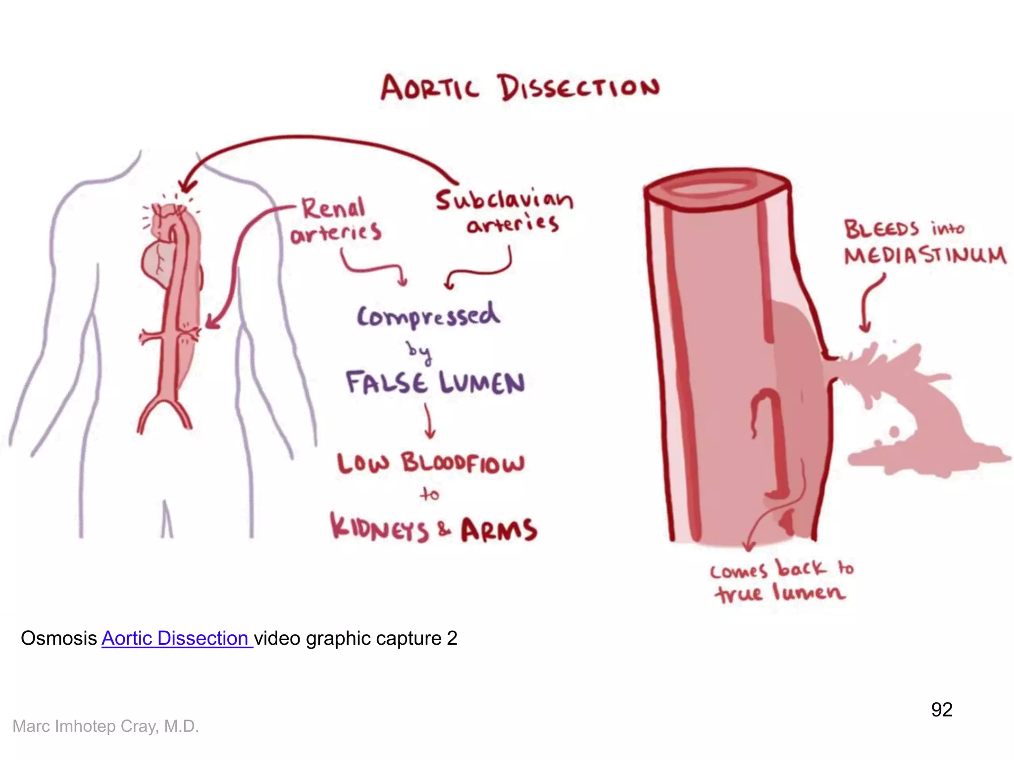 Marc Imhotep Cray, M.D.
92
Osmosis Aortic Dissection video graphic capture 2
 