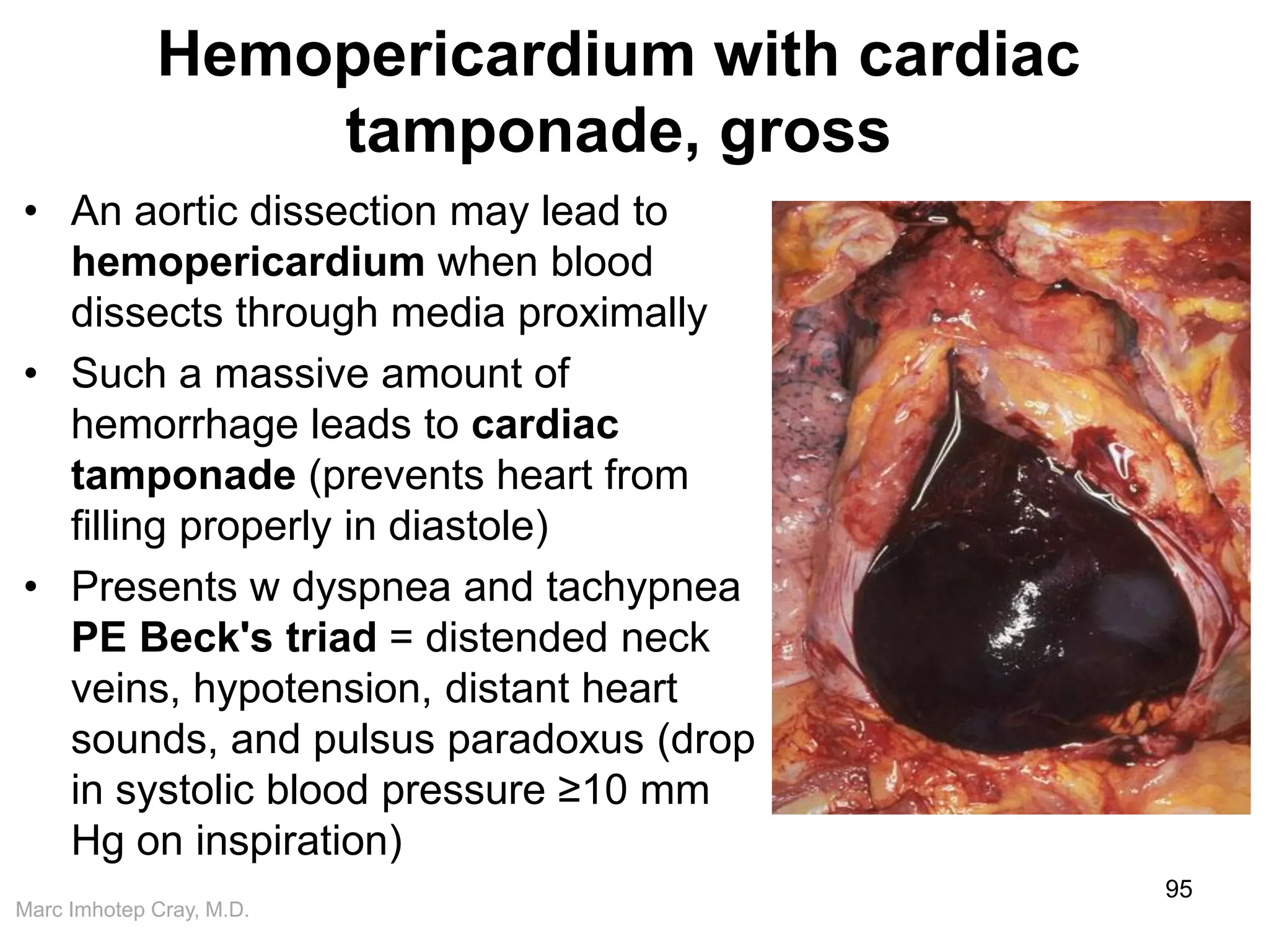Marc Imhotep Cray, M.D.
Hemopericardium with cardiac
tamponade, gross
• An aortic dissection may lead to
hemopericardium when blood
dissects through media proximally
• Such a massive amount of
hemorrhage leads to cardiac
tamponade (prevents heart from
filling properly in diastole)
• Presents w dyspnea and tachypnea
PE Beck's triad = distended neck
veins, hypotension, distant heart
sounds, and pulsus paradoxus (drop
in systolic blood pressure ≥10 mm
Hg on inspiration)
95
 