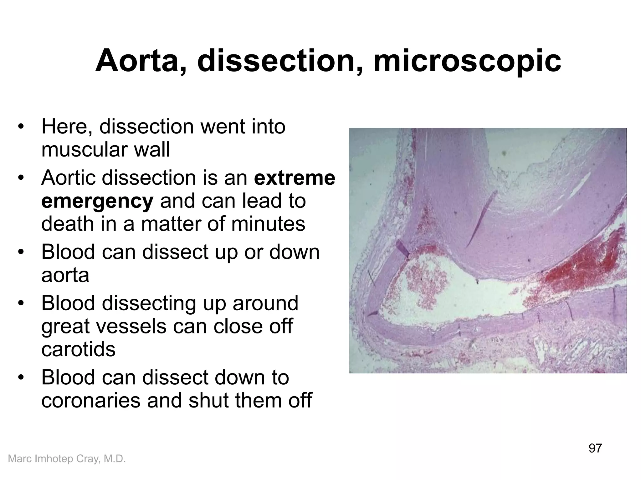 Marc Imhotep Cray, M.D.
Aorta, dissection, microscopic
• Here, dissection went into
muscular wall
• Aortic dissection is an extreme
emergency and can lead to
death in a matter of minutes
• Blood can dissect up or down
aorta
• Blood dissecting up around
great vessels can close off
carotids
• Blood can dissect down to
coronaries and shut them off
97
 
