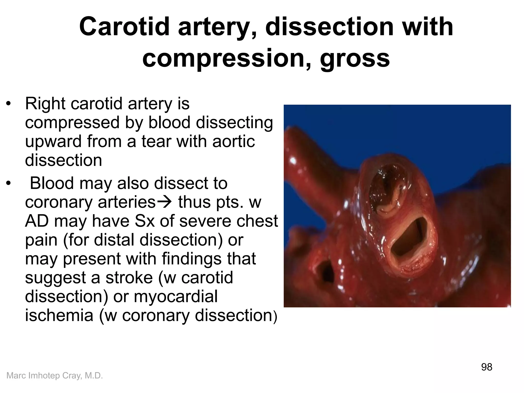 Marc Imhotep Cray, M.D.
Carotid artery, dissection with
compression, gross
• Right carotid artery is
compressed by blood dissecting
upward from a tear with aortic
dissection
• Blood may also dissect to
coronary arteries thus pts. w
AD may have Sx of severe chest
pain (for distal dissection) or
may present with findings that
suggest a stroke (w carotid
dissection) or myocardial
ischemia (w coronary dissection)
98
 