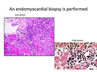 An endomyocardial biopsy is performed
.
Low power
High power
 