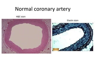Normal coronary artery
H&E stain
Elastin stain
 