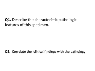 Q1. Describe the characteristic pathologic
features of this specimen.
Q2. Correlate the clinical findings with the pathology
 