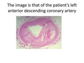 The image is that of the patient’s left
anterior descending coronary artery
 