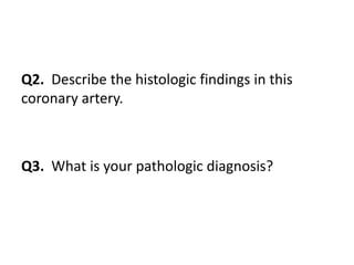 Q2. Describe the histologic findings in this
coronary artery.
Q3. What is your pathologic diagnosis?
 