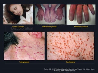 Skin
Inspection
• Cyanosis – Central, Peripheral and Differential
• Skin Discoloration – Jaundice, Tan or Bronze
Discoloration
• Telangiectasias
• Xanthelasmas/Xanthomas
• Lentiginoses
• Pernio
• Erythema nodosum
Central Cyanosis Differential Cyanosis Peripheral Cyanosis
Telangiectasia Xanthelasma
Porter, R.S. 2018. The Merck Manual of Diagnosis and Therapy 20th Edition. Merck
Publishing. ISBN 978-0911910421
 