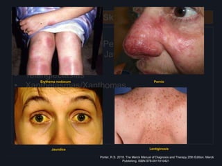 Skin
Inspection
• Cyanosis – Central, Peripheral and Differential
• Skin Discoloration – Jaundice, Tan or Bronze
Discoloration
• Telangiectasias
• Xanthelasmas/Xanthomas
• Lentiginoses
• Pernio
• Erythema nodosum
Lentiginosis
Erythema nodosum Pernio
Porter, R.S. 2018. The Merck Manual of Diagnosis and Therapy 20th Edition. Merck
Publishing. ISBN 978-0911910421
Jaundice
 