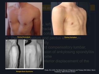 Neck, Chest and Precordium
CHEST
Inspection
• Midline sternotomy, left posterolateral
thoracotomy, or infraclavicular scars
• Prominent venous collateral pattern
• Pectus carinatum and pectus excavatum
• Barrel chest deformity
• Severe kyphosis and compensatory lumbar,
pelvic, and knee flexion of ankylosing spondylitis
• Straight back syndrome
• Asymmetric, with anterior displacement of the
left hemithorax
Pectus Excavatum Pectus Carinatum
Straight Back Syndrome
Porter, R.S. 2018. The Merck Manual of Diagnosis and Therapy 20th Edition. Merck
Publishing. ISBN 978-0911910421
 