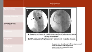 Epidemiology
Clinical Features
Investigations
Treatment
Prognosis
Follow up
Angiography
 