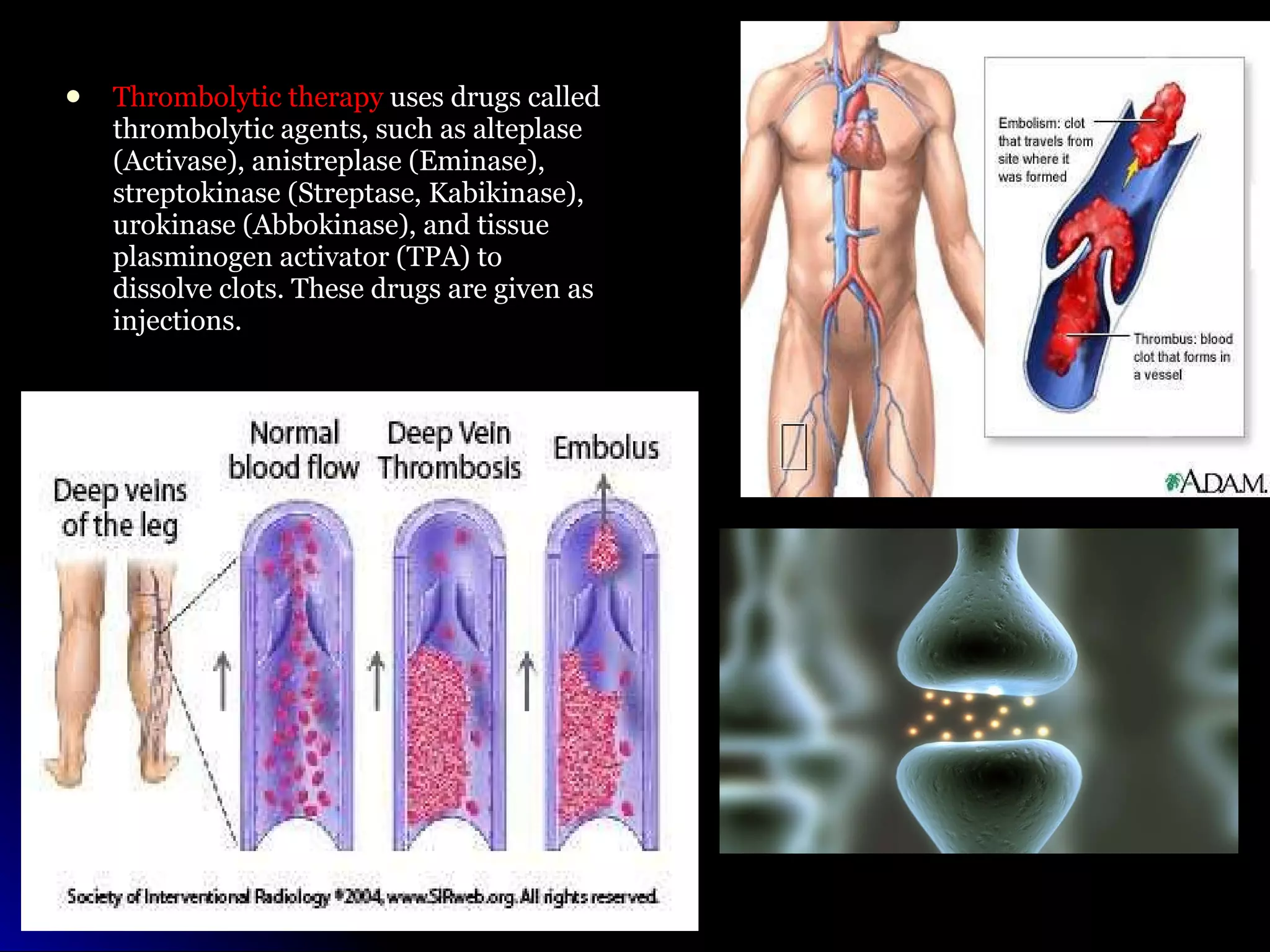 Thrombolytic therapy  uses drugs called thrombolytic agents, such as alteplase (Activase), anistreplase (Eminase), streptokinase (Streptase, Kabikinase), urokinase (Abbokinase), and tissue plasminogen activator (TPA) to dissolve clots. These drugs are given as injections. 