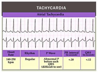 TACHYCARDIA
 