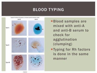 BLOOD T YPING

       Blood samples are
        mixed with anti-A
        and anti-B serum to
        check for
        agglutination
        (clumping)
       Typing for Rh factors
        is done in the same
        manner
 