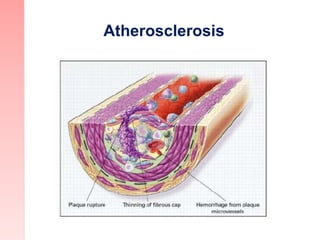 Thrombosis Influences the Severity
of a Cardiovascular Event
Nonocclusive thrombus Occlusive thrombus
• Unstable angina
• ...
