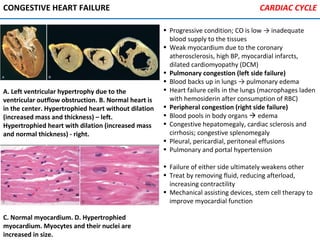 CONGESTIVE HEART FAILURE
• Progressive condition; CO is low → inadequate
blood supply to the tissues
• Weak myocardium due to the coronary
atherosclerosis, high BP, myocardial infarcts,
dilated cardiomyopathy (DCM)
• Pulmonary congestion (left side failure)
• Blood backs up in lungs → pulmonary edema
• Heart failure cells in the lungs (macrophages laden
with hemosiderin after consumption of RBC)
• Peripheral congestion (right side failure)
• Blood pools in body organs  edema
• Congestive hepatomegaly, cardiac sclerosis and
cirrhosis; congestive splenomegaly
• Pleural, pericardial, peritoneal effusions
• Pulmonary and portal hypertension
• Failure of either side ultimately weakens other
• Treat by removing fluid, reducing afterload,
increasing contractility
• Mechanical assisting devices, stem cell therapy to
improve myocardial function
A. Left ventricular hypertrophy due to the
ventricular outflow obstruction. B. Normal heart is
in the center. Hypertrophied heart without dilation
(increased mass and thickness) – left.
Hypertrophied heart with dilation (increased mass
and normal thickness) - right.
C. Normal myocardium. D. Hypertrophied
myocardium. Myocytes and their nuclei are
increased in size.
CARDIAC CYCLE
 