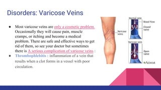 Disorders: Varicose Veins
● Most varicose veins are only a cosmetic problem.
Occasionally they will cause pain, muscle
cramps, or itching and become a medical
problem. There are safe and effective ways to get
rid of them, so see your doctor but sometimes
there is A serious complication of varicose veins :
● Thrombophlebitis : inflammation of a vein that
results when a clot forms in a vessel with poor
circulation.
 