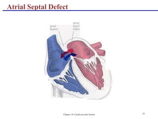 Chapter 18, Cardiovascular System 19
Atrial Septal Defect
 