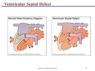 Chapter 18, Cardiovascular System 20
Ventricular Septal Defect
 