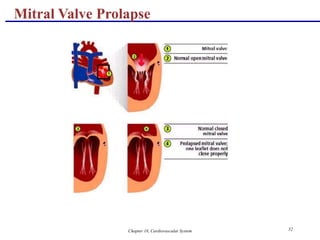 Chapter 18, Cardiovascular System 32
Mitral Valve Prolapse
 