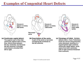 Chapter 18, Cardiovascular System 82
Figure 18.25
Examples of Congenital Heart Defects
 