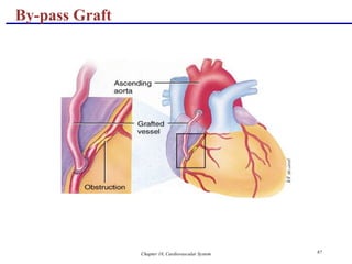 Chapter 18, Cardiovascular System 87
By-pass Graft
 