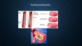 Arteriosclerosis:
 