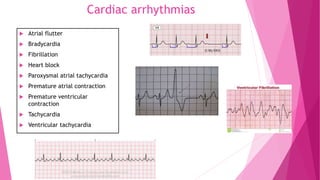 Cardiac arrhythmias
 Atrial flutter
 Bradycardia
 Fibrillation
 Heart block
 Paroxysmal atrial tachycardia
 Premature atrial contraction
 Premature ventricular
contraction
 Tachycardia
 Ventricular tachycardia
 