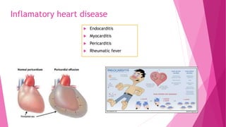 Inflamatory heart disease
 Endocarditis
 Myocarditis
 Pericarditis
 Rheumatic fever
 