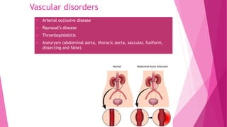 Vascular disorders
 Arterial occlusive disease
 Raynaud’s disease
 Thrombophlebitis
 Aneurysm (abdominal aorta, thoracic aorta, saccular, fusiform,
dissecting and false)
 