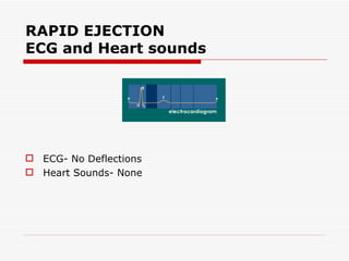 RAPID EJECTION ECG and Heart sounds ECG- No Deflections Heart Sounds- None  