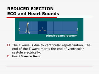 REDUCED EJECTION ECG and Heart Sounds The T wave is due to ventricular repolarization. The end of the T wave marks the end of ventricular systole electrically.  Heart Sounds- None  