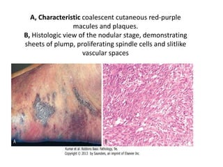 Coalescent Rash Cardiovascular system pathology lab | PDF