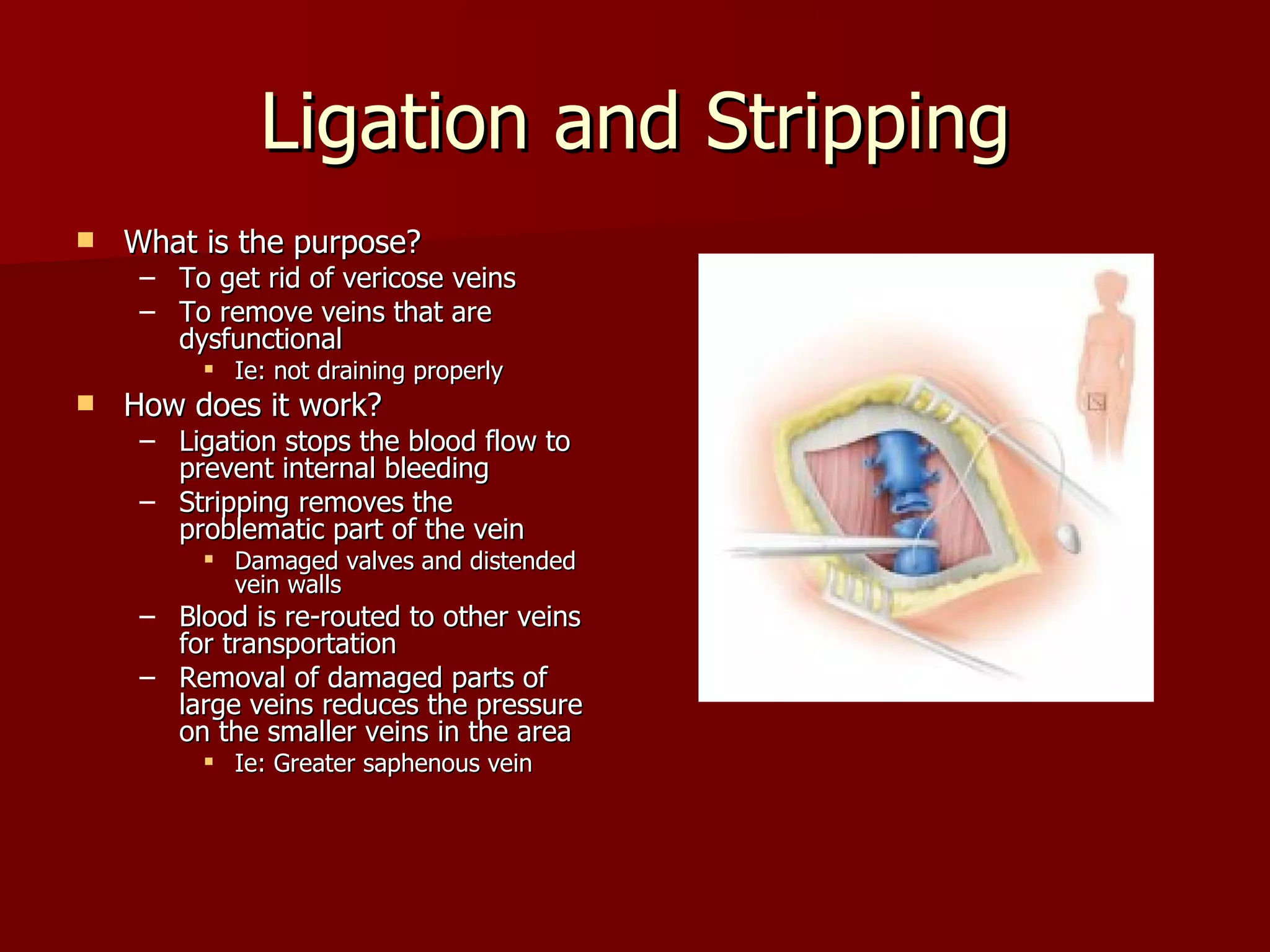 Ligation and Stripping What is the purpose? To get rid of vericose veins To remove veins that are dysfunctional Ie: not draining properly How does it work? Ligation stops the blood flow to prevent internal bleeding Stripping removes the problematic part of the vein Damaged valves and distended vein walls Blood is re-routed to other veins for transportation Removal of damaged parts of large veins reduces the pressure on the smaller veins in the area Ie: Greater saphenous vein 
